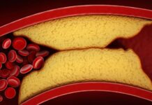 MÉDICO VASCULAR APONTA O QUE AJUDA A REDUZIR A GORDURA NAS ARTÉRIAS